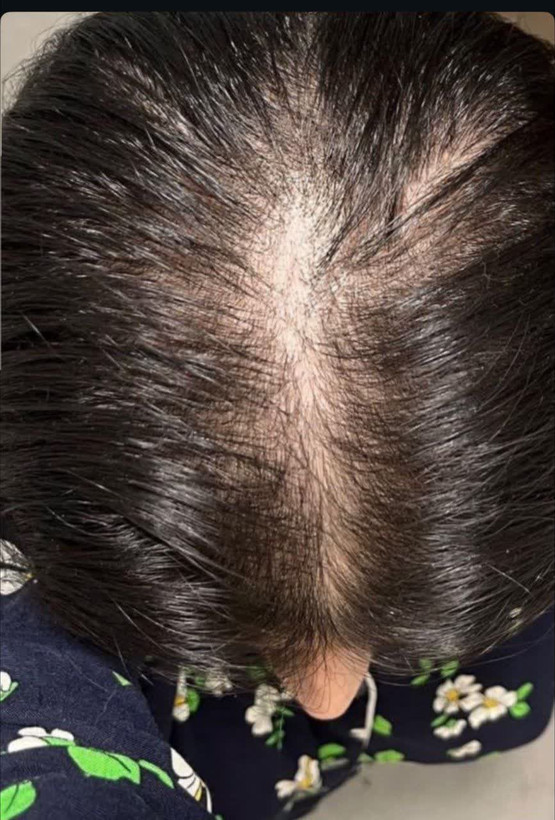 تونیک گیاهی هیرفرند بدون مواد شیمیایی و ماینوکسیدیل افزایش قدی مو و جواگیری از ریزش مو وپرپشتی مو