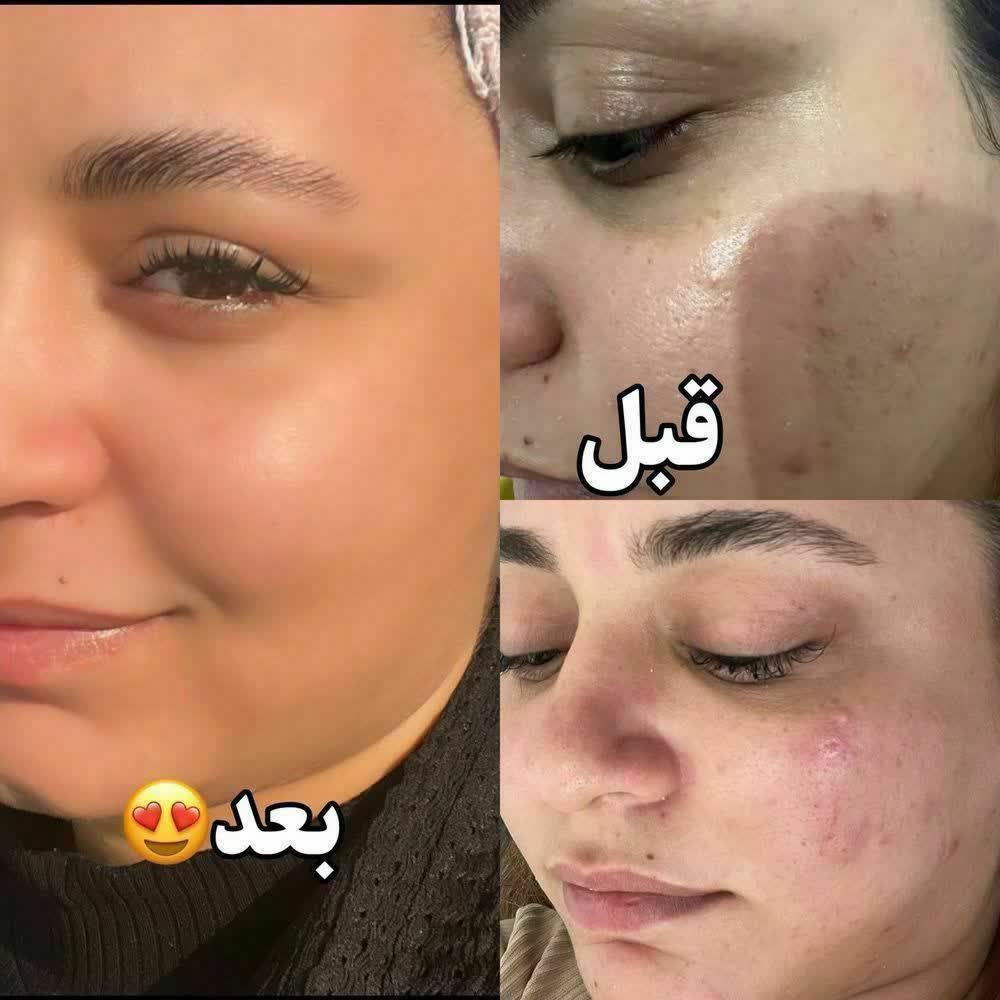 كرم ضدجوش وضد آكنه بيوممتيك باپك كامل باضمانت