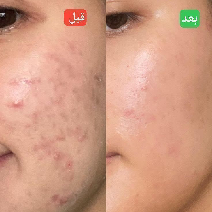 كرم ضدجوش وضد آكنه بيوممتيك باپك كامل باضمانت