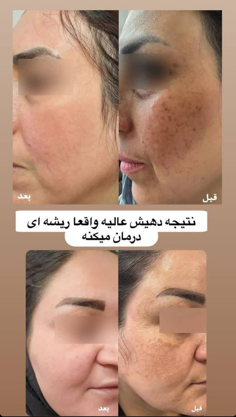 سرم مغذي همه كاره بيوممتيك لاكچري كوين فرانسه بمب هلويي صورت