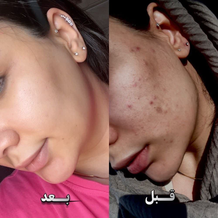 سرم مغذي همه كاره بيوممتيك لاكچري كوين فرانسه بمب هلويي صورت