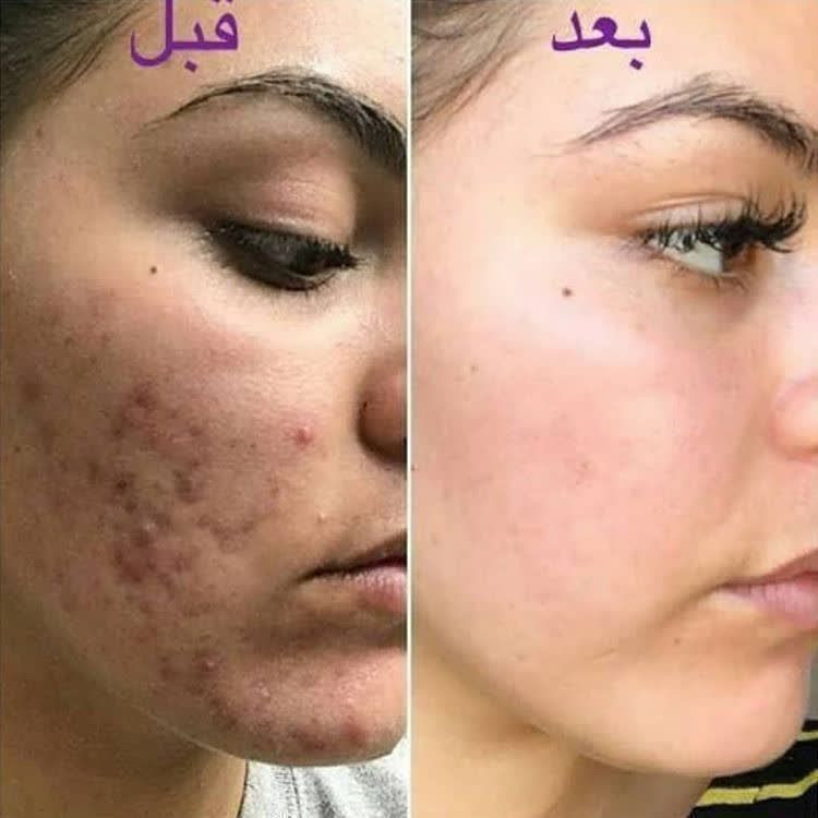 کرم ضدجوش بیوممتیک معجزه قرن
