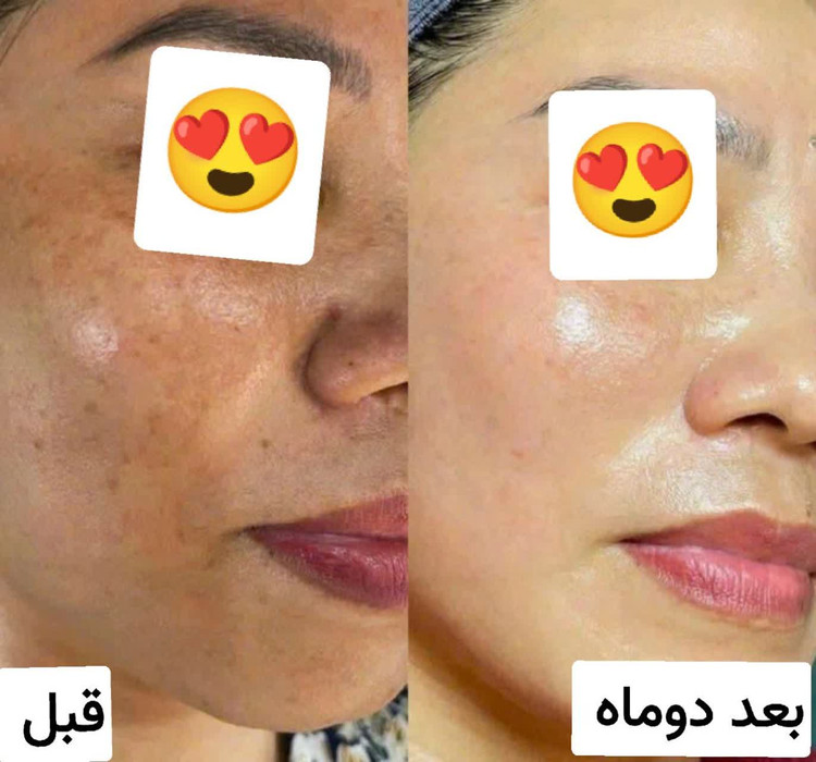 كرم ضدلك و روشن كننده بيوممتيك پوست هلويي و نچرال و زيبا