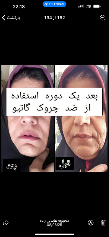 كرم بوتاكس گاتيو بيوممتيك اصل داراي باركد جايگزين بوتاكس و روشهاي تهاجمي